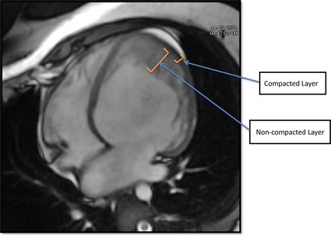 noncompaction cardiomyopathy mri